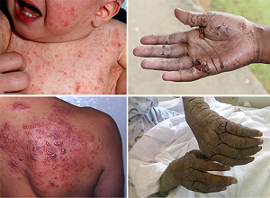 Immigration1scabies-victims
